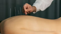 Acupuncture