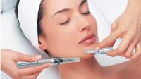 Microneedling