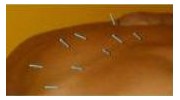 Acupuncture