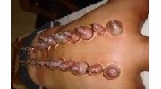 Cupping Therapy